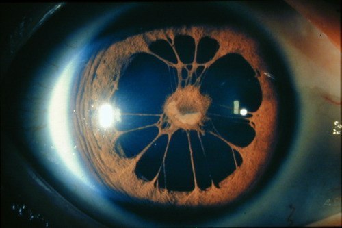 Поликория — редко встречающийся врожденный дефект глаза: наличие в радужке двух или нескольких зрачковых отверстий.